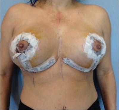Breast Implant Revision Before & After Gallery - Patient 13947236 - Image 2