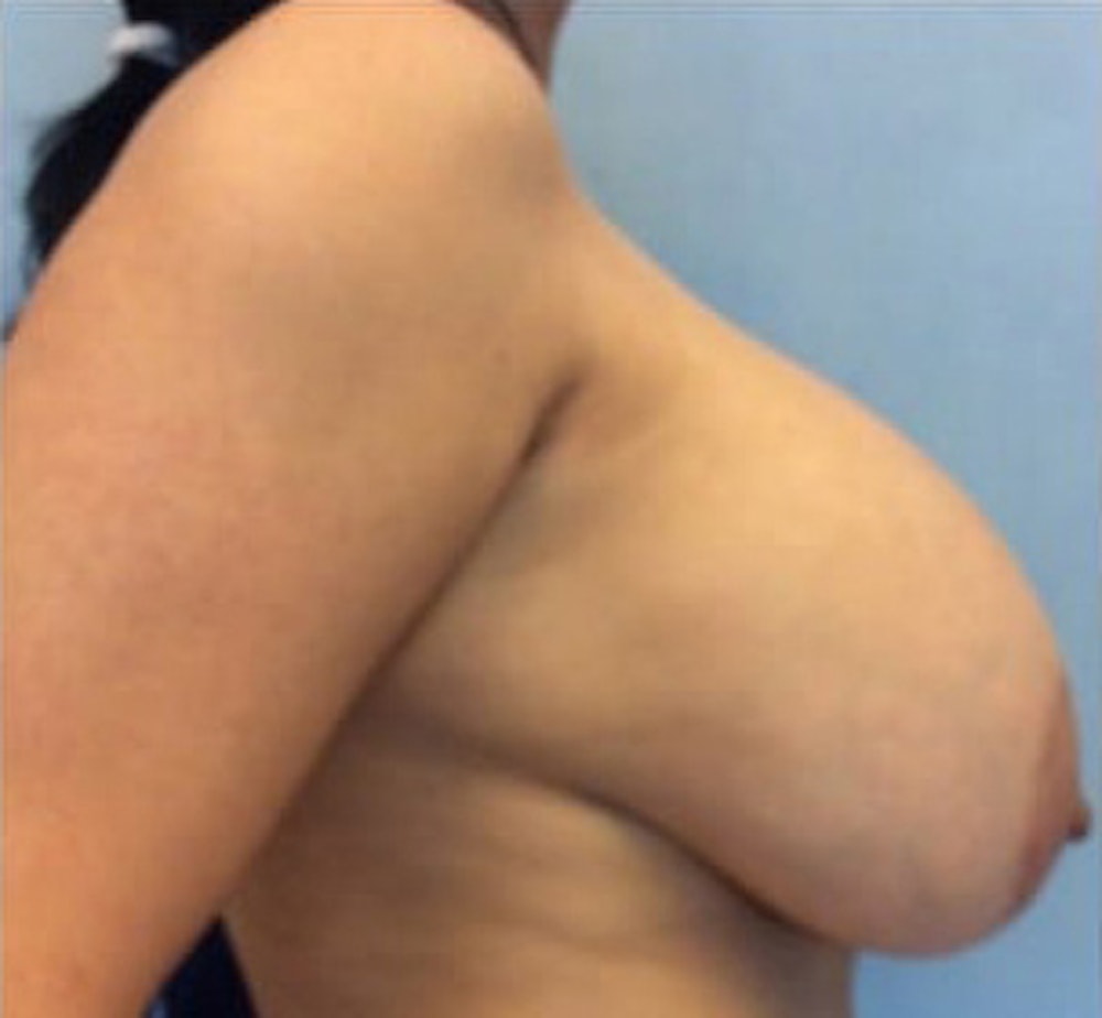 Breast Implant Revision Before & After Gallery - Patient 13947236 - Image 3