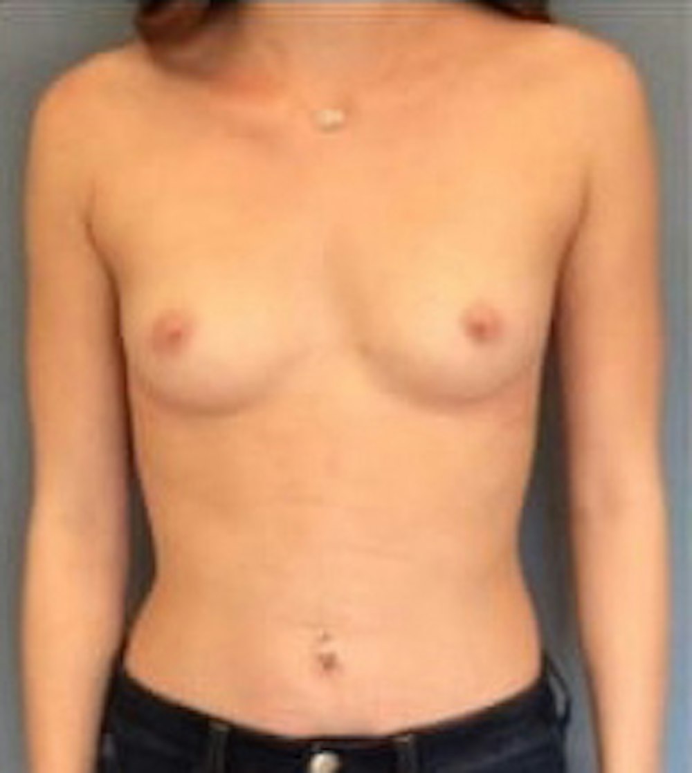 Breast Augmentation Gallery - Patient 13947005 - Image 1
