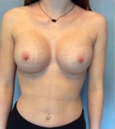 Breast Augmentation Before & After Gallery - Patient 13947005 - Image 2