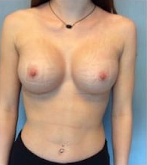 Breast Augmentation Gallery - Patient 13947005 - Image 2
