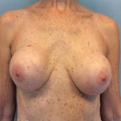 Breast Implant Revision Before & After Gallery - Patient 13947238 - Image 1