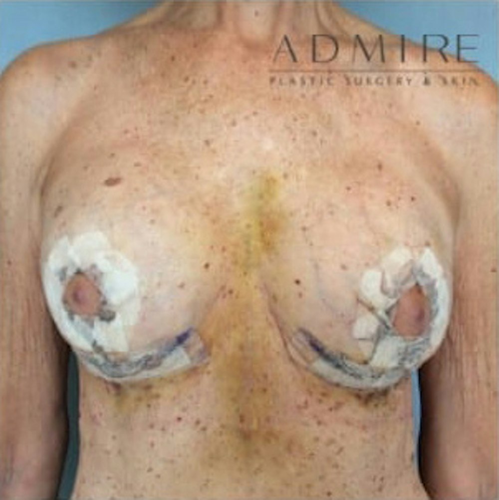 Breast Implant Revision Gallery - Patient 13947238 - Image 2