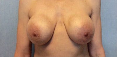 Breast Implant Revision Before & After Gallery - Patient 13947239 - Image 1