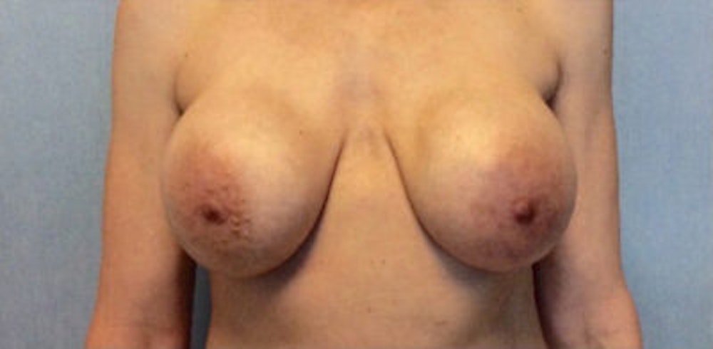 Breast Implant Revision Before & After Gallery - Patient 13947239 - Image 1