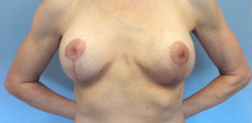 Breast Implant Revision Before & After Gallery - Patient 13947239 - Image 2
