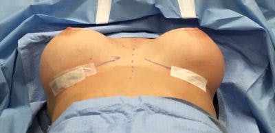 Breast Implant Revision Before & After Gallery - Patient 13947240 - Image 2