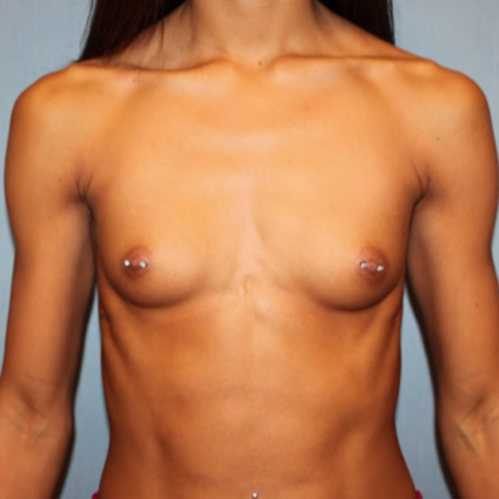 Breast Augmentation Before & After Gallery - Patient 13947009 - Image 1