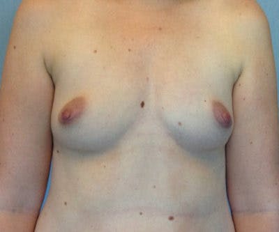 Breast Augmentation Before & After Gallery - Patient 13947011 - Image 1