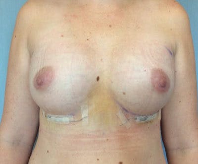 Breast Augmentation Before & After Gallery - Patient 13947011 - Image 2