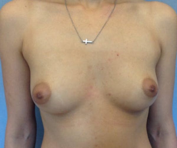 Breast Augmentation Gallery - Patient 13947012 - Image 1