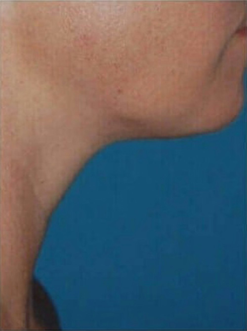 Liposuction Before & After Gallery - Patient 13947245 - Image 2