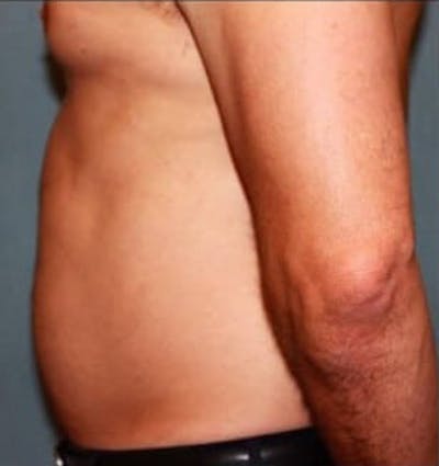 Liposuction Gallery - Patient 13947246 - Image 1