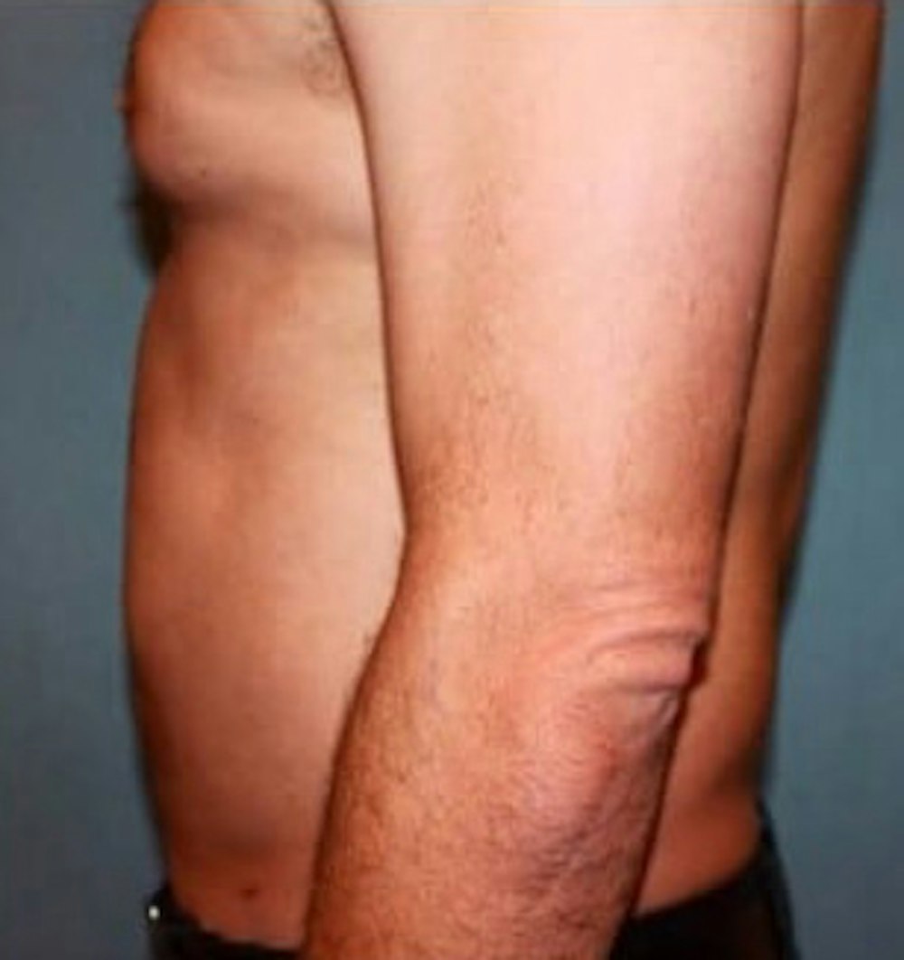 Liposuction Before & After Gallery - Patient 13947246 - Image 2