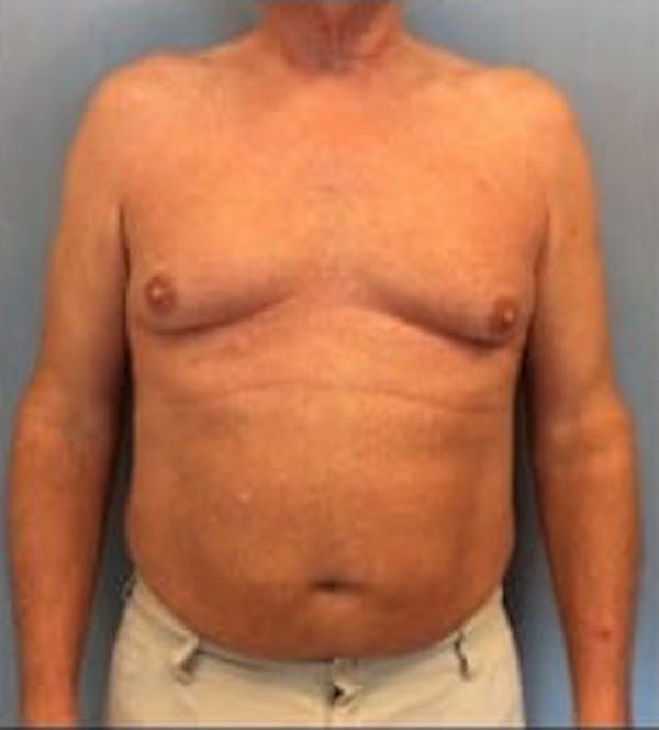 Liposuction Gallery - Patient 13947247 - Image 1