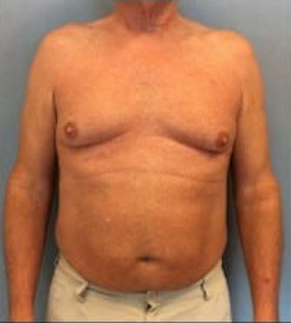 Liposuction Before & After Gallery - Patient 13947247 - Image 1