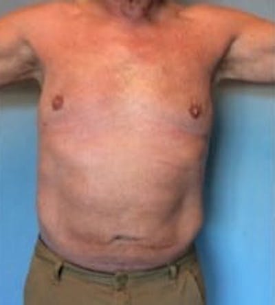 Liposuction Gallery - Patient 13947247 - Image 2