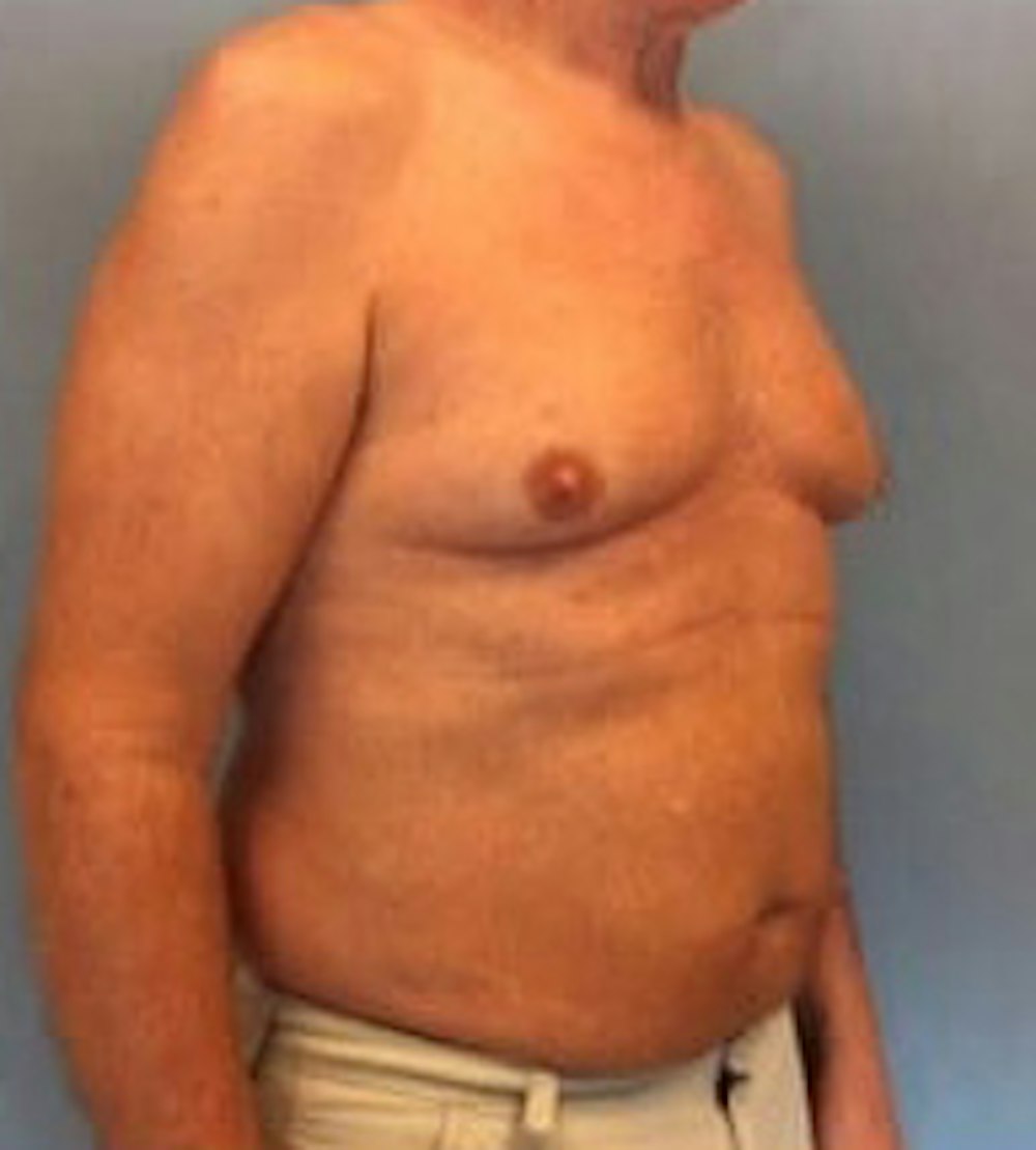Liposuction Before & After Gallery - Patient 13947247 - Image 3