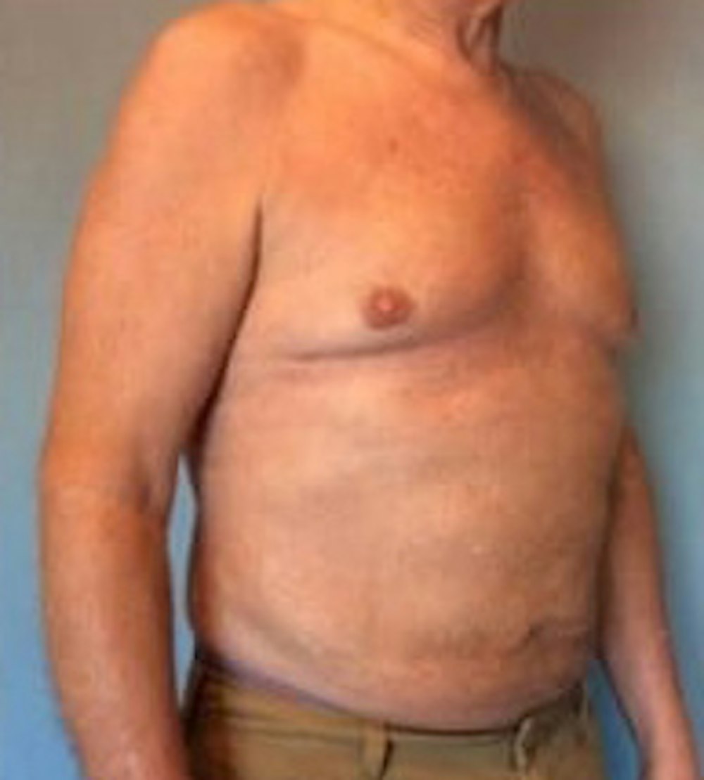 Liposuction Before & After Gallery - Patient 13947247 - Image 4