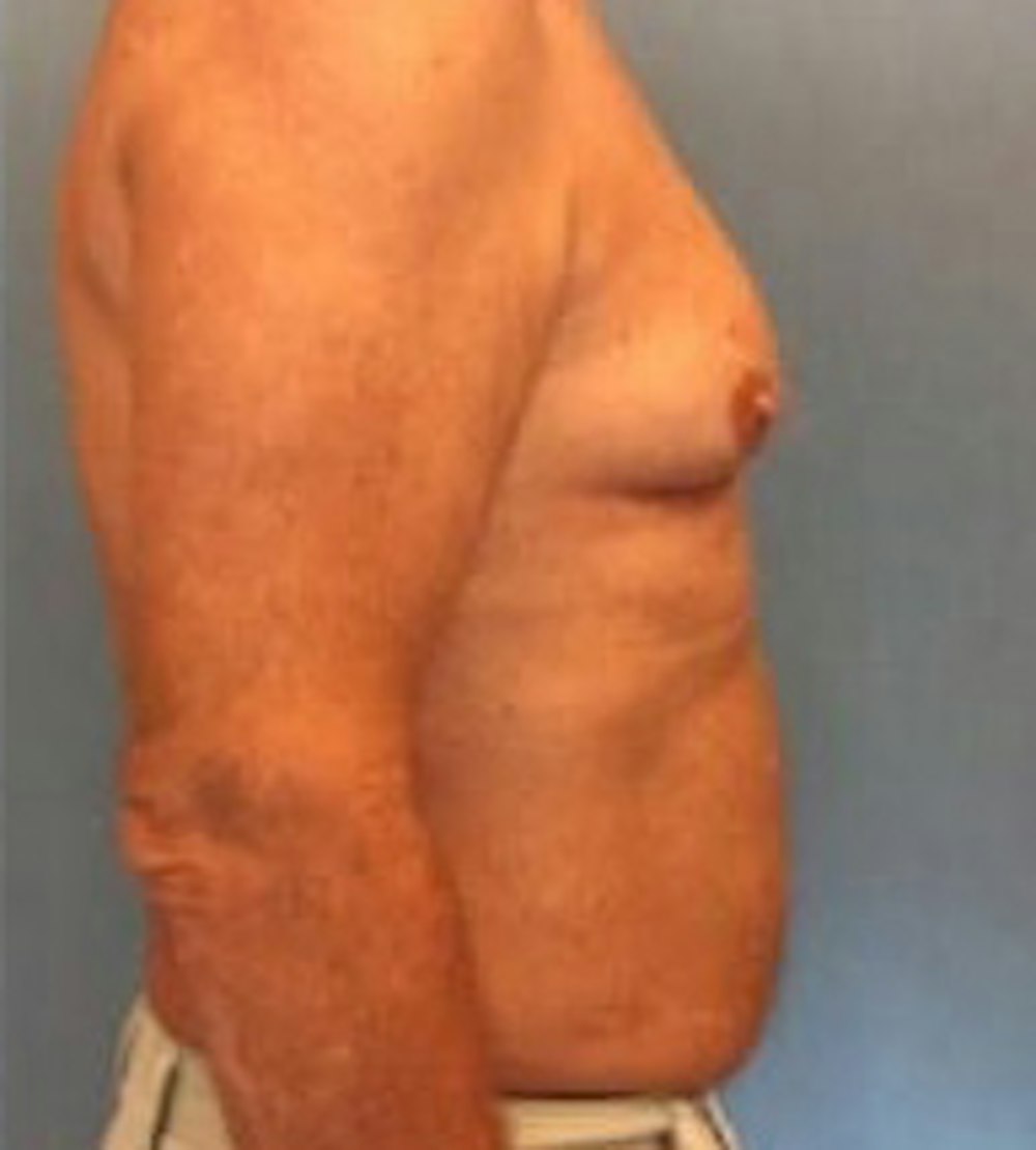 Liposuction Gallery - Patient 13947247 - Image 5