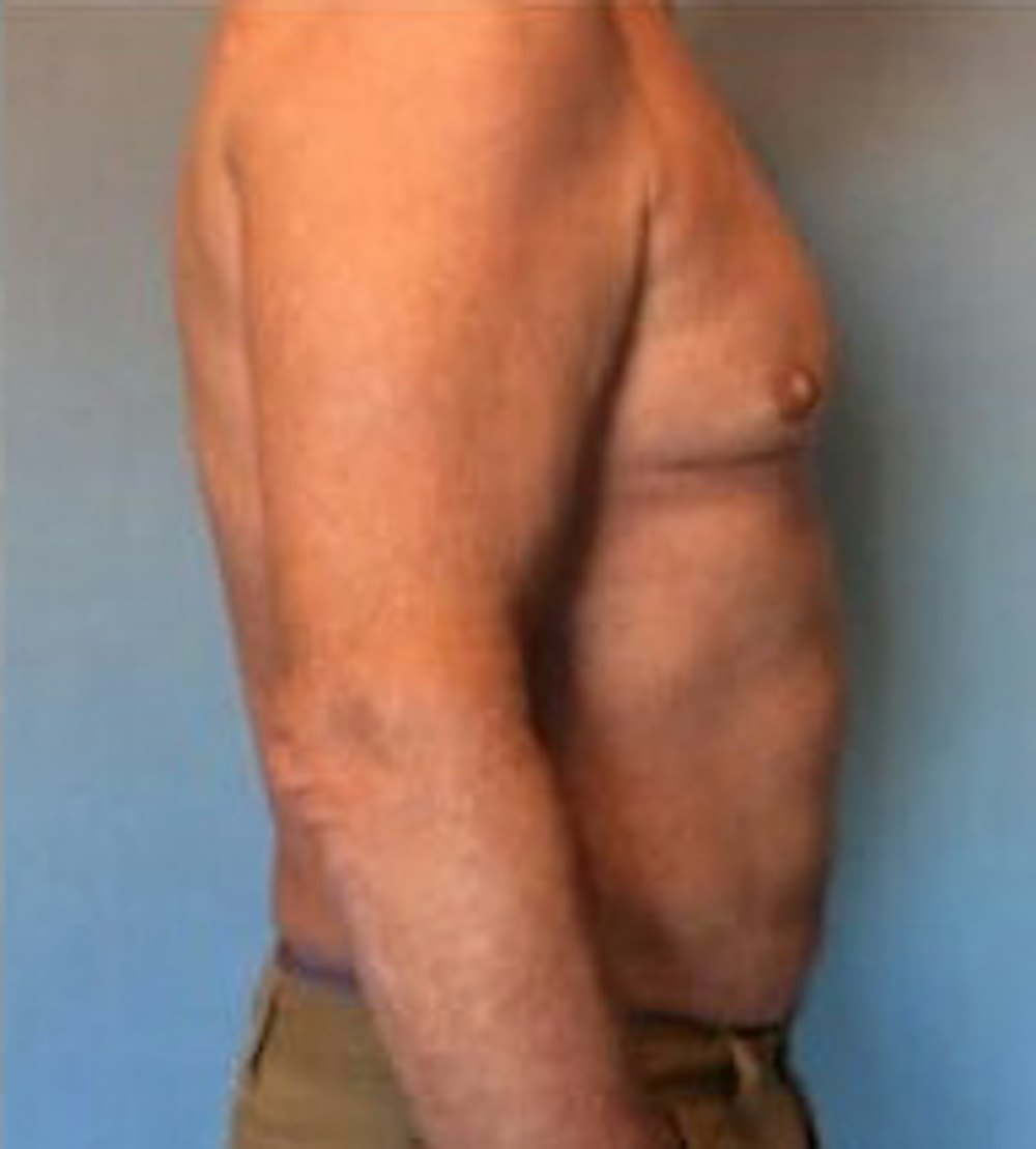 Liposuction Before & After Gallery - Patient 13947247 - Image 6