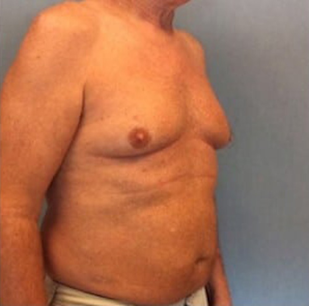 Liposuction Before & After Gallery - Patient 13947247 - Image 7