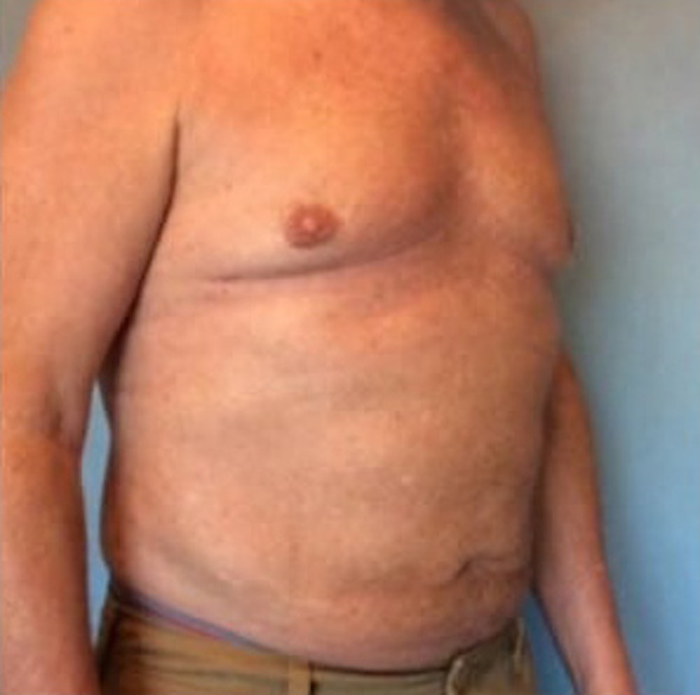 Liposuction Before & After Gallery - Patient 13947247 - Image 8