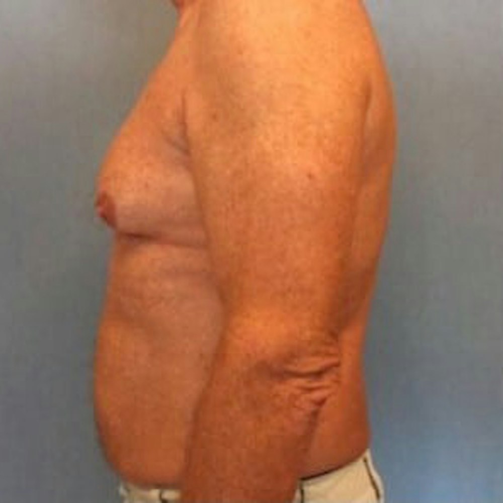 Liposuction Before & After Gallery - Patient 13947247 - Image 9