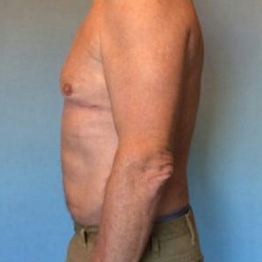 Liposuction Gallery - Patient 13947247 - Image 10