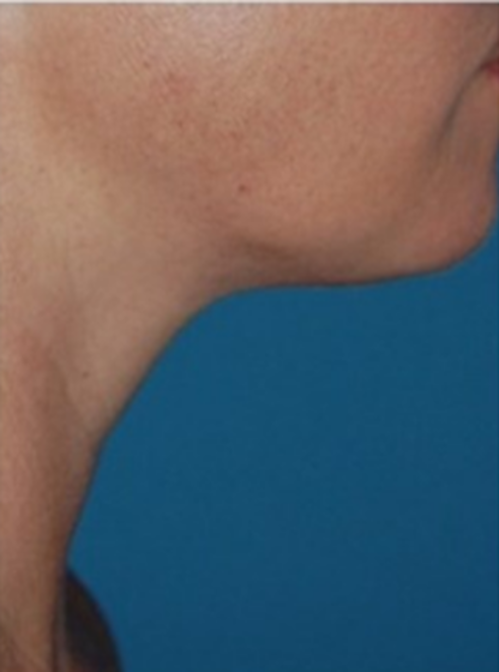 Liposuction Before & After Gallery - Patient 13947248 - Image 2