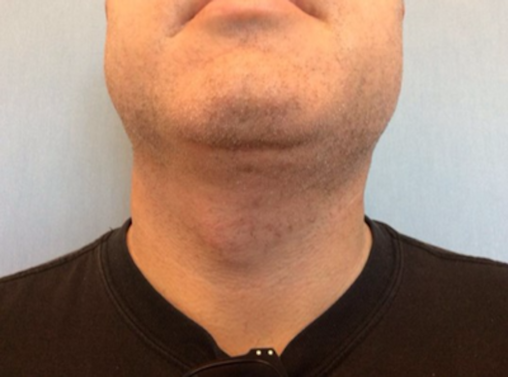Liposuction Before & After Gallery - Patient 13947249 - Image 2