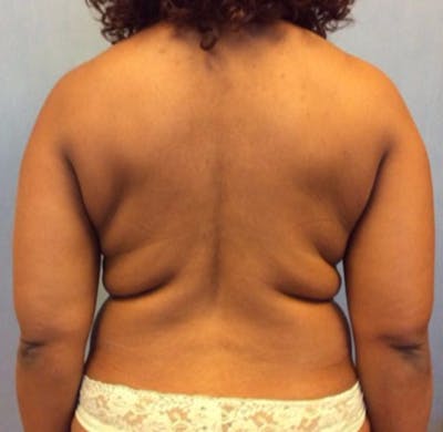 Liposuction Before & After Gallery - Patient 13947250 - Image 1