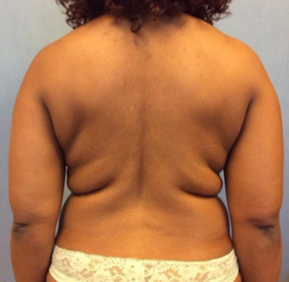 Liposuction Before & After Gallery - Patient 13947250 - Image 1