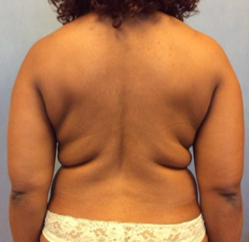 Liposuction Gallery - Patient 13947250 - Image 1