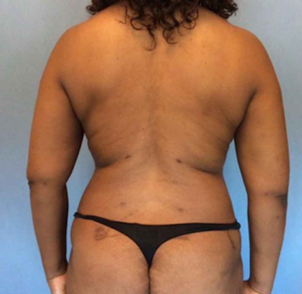 Liposuction Before & After Gallery - Patient 13947250 - Image 2
