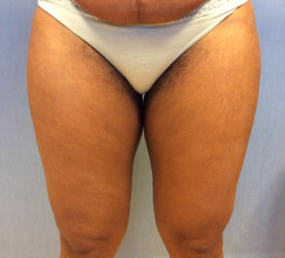 Liposuction Before