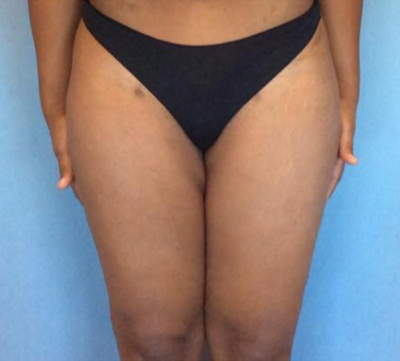 Liposuction After