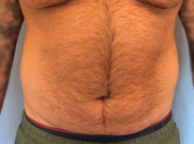 Liposuction Before & After Gallery - Patient 13947252 - Image 1