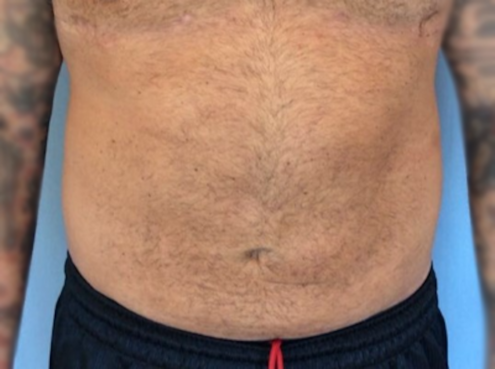 Liposuction Before & After Gallery - Patient 13947252 - Image 2