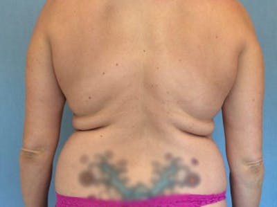 Liposuction Before & After Gallery - Patient 13947253 - Image 1
