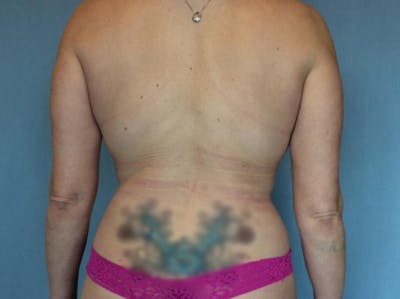 Liposuction Before & After Gallery - Patient 13947253 - Image 2