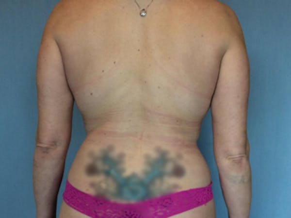 Liposuction Gallery - Patient 13947253 - Image 2