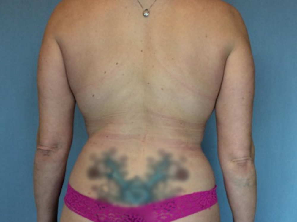 Liposuction Before & After Gallery - Patient 13947253 - Image 2