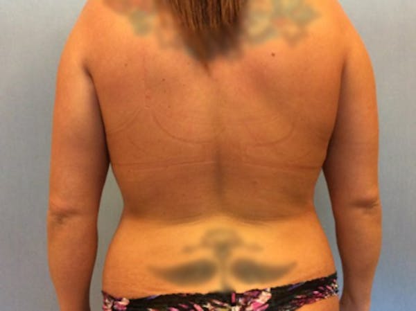 Liposuction Gallery - Patient 13947254 - Image 1