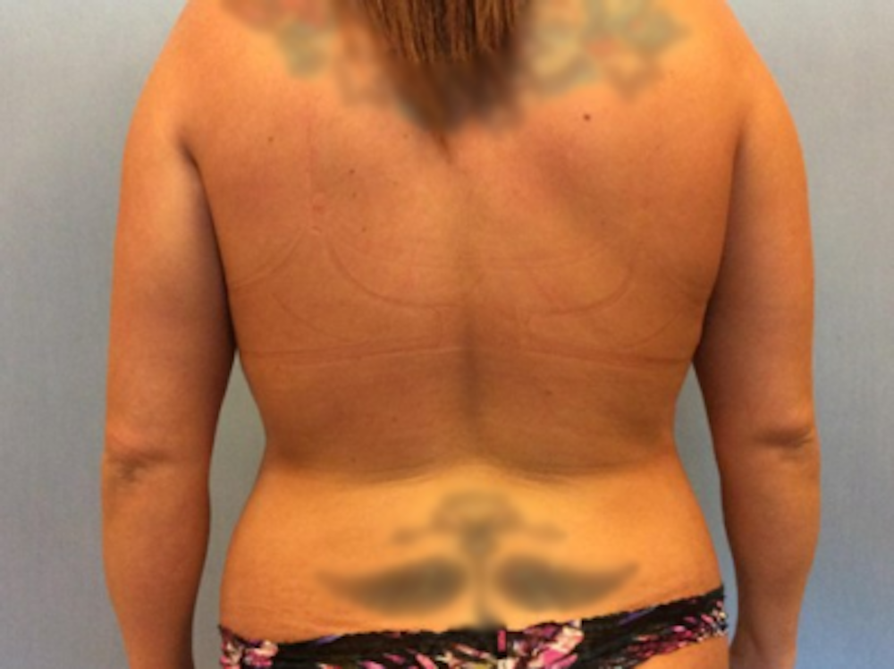 Liposuction Before & After Gallery - Patient 13947254 - Image 1