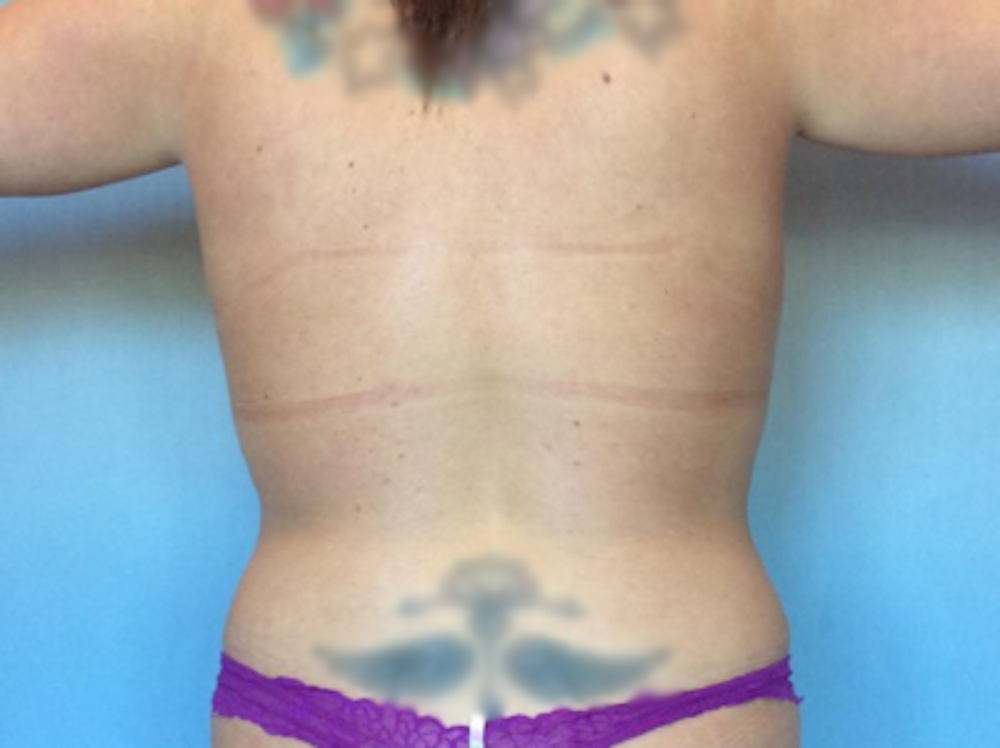 Liposuction Gallery - Patient 13947254 - Image 2