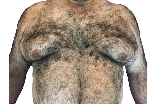 Male Breast Reduction Before