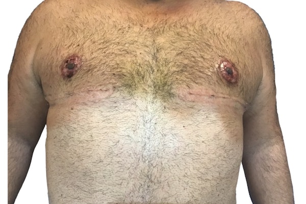 Male Breast Reduction After