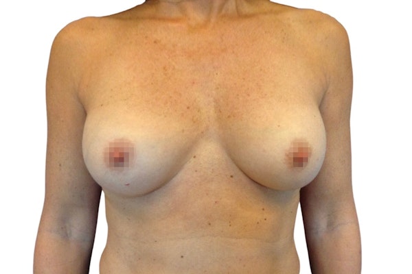 Breast Augmentation Before