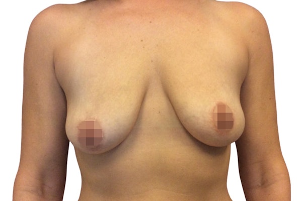 Breast Augmentation Before